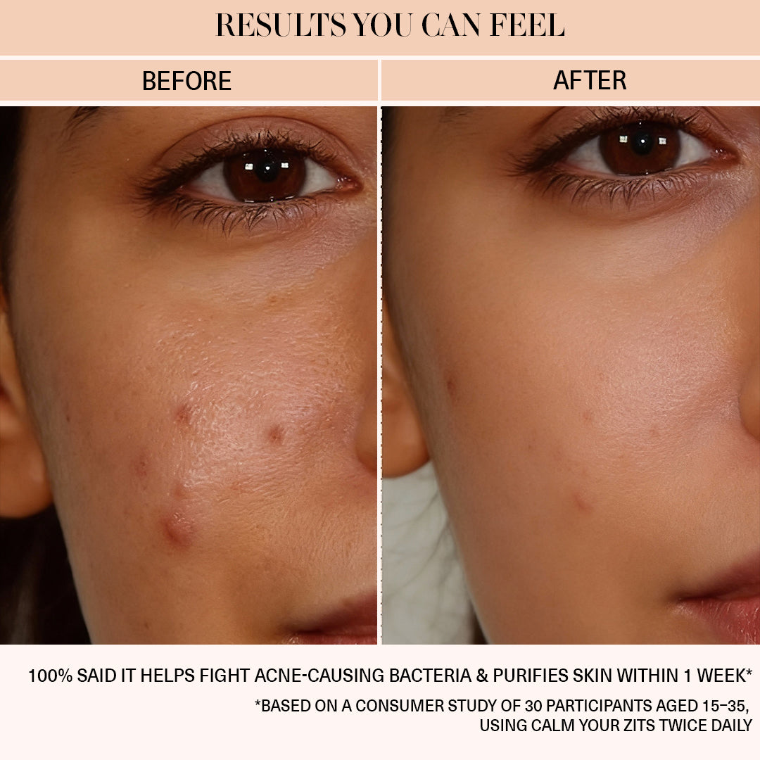 Calm Your Zits - Anti-Acne Gel