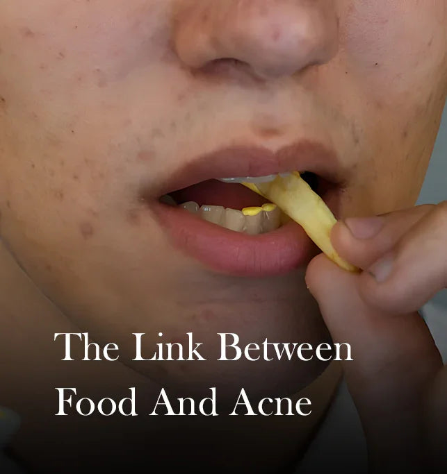 From Plate to Pimple: Foods That Trigger Acne