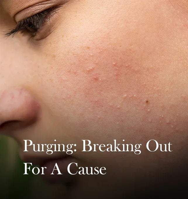 What is Skin Purging and What Causes It?