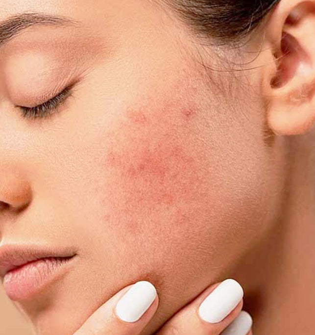 Acne Trouble? 3 Ways of Removing Dead Skin From Your Face