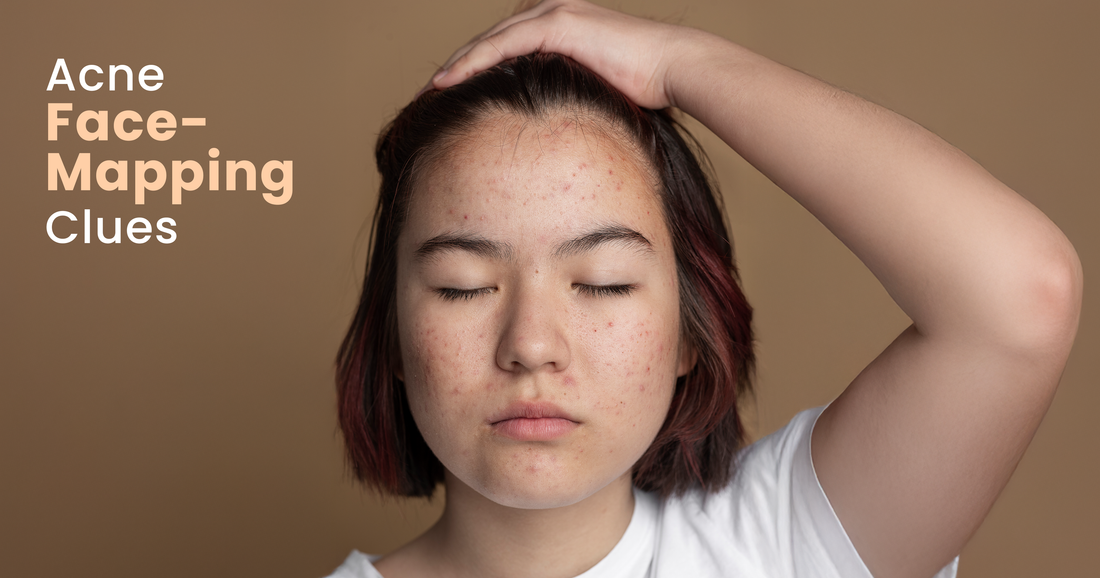 Acne Face Mapping: Causes of Breakouts on Your Face