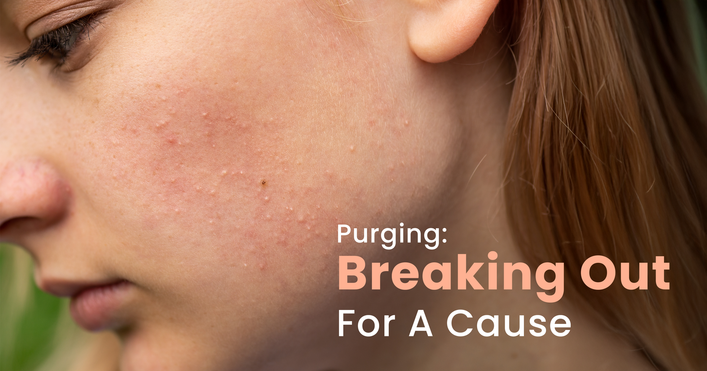 skin purging