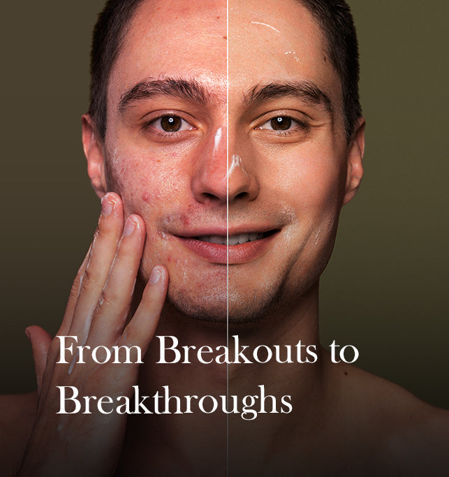 Say Goodbye to Acne: Understanding the Different Types of Acne and How to Treat Them