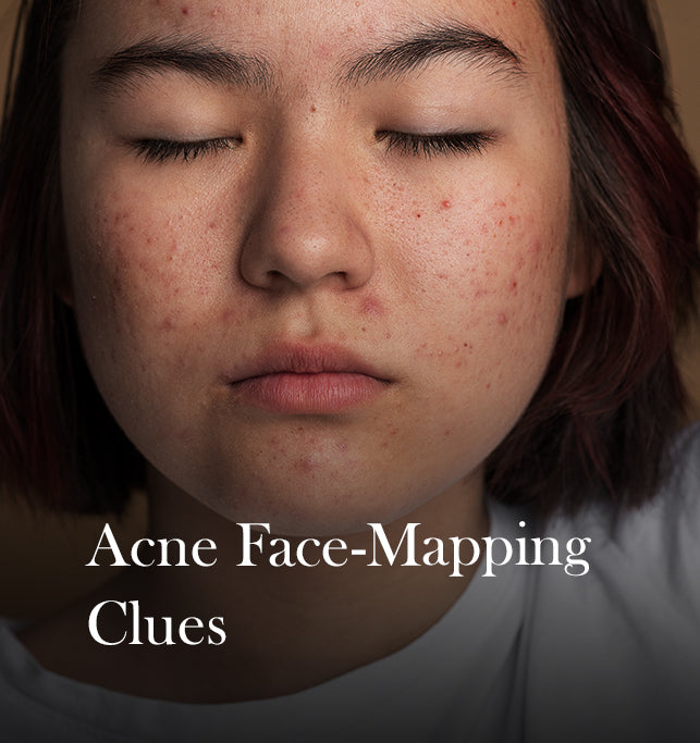 Reading the Signs: How to Identify the Causes of Acne Based on Where It Appears on Your Face