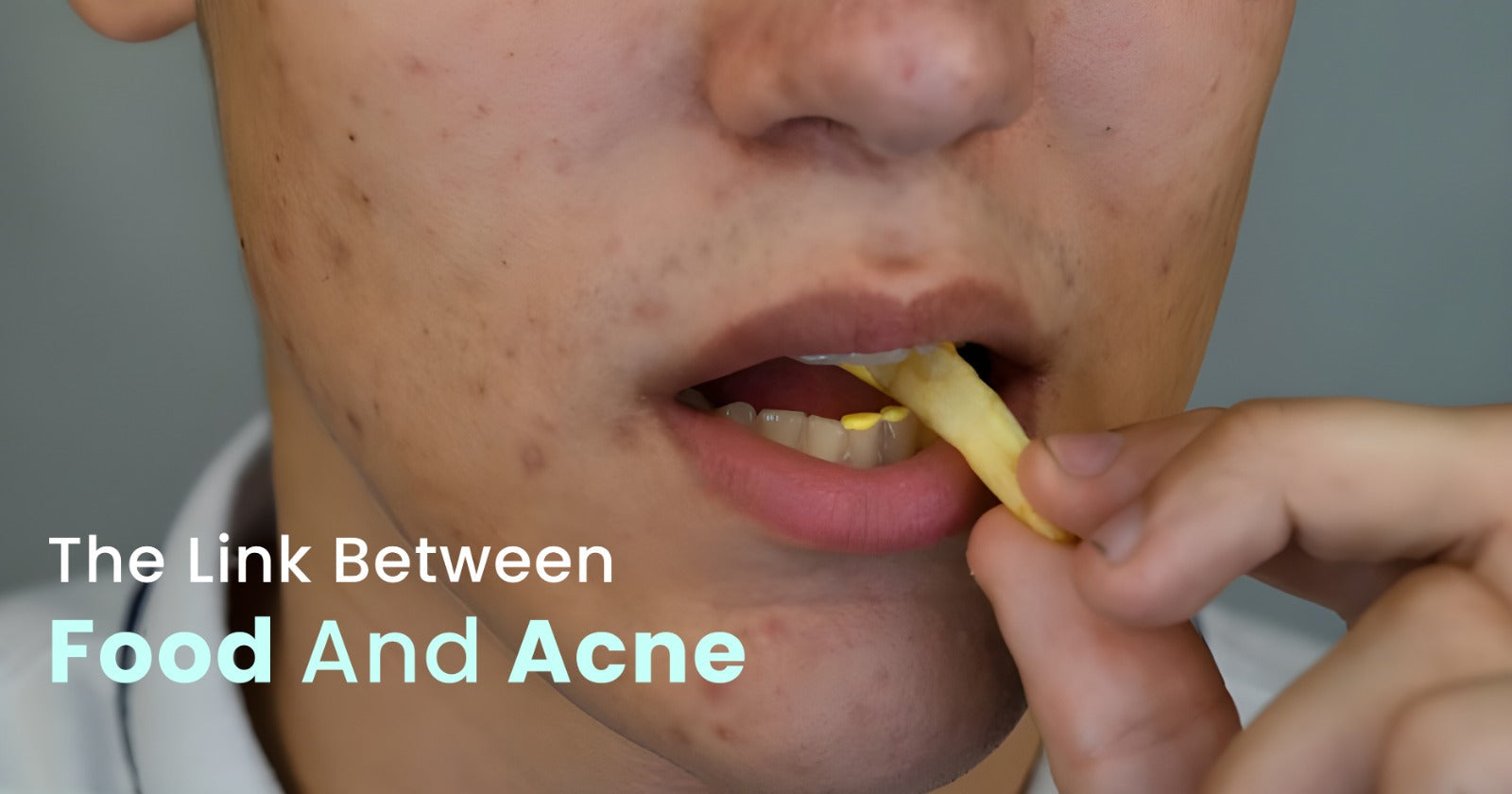 Foods does cause acne