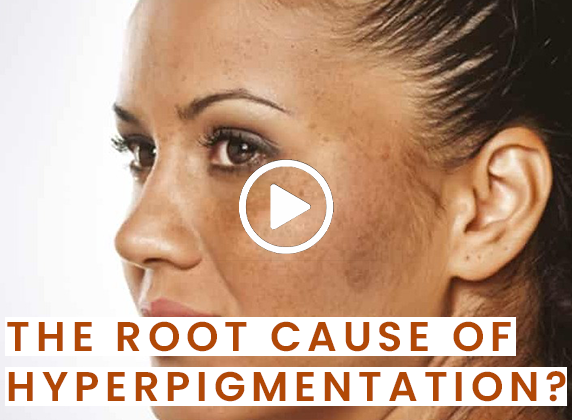 SKIN RESET | What Is Hyperpigmentation and How to Get Rid of It?