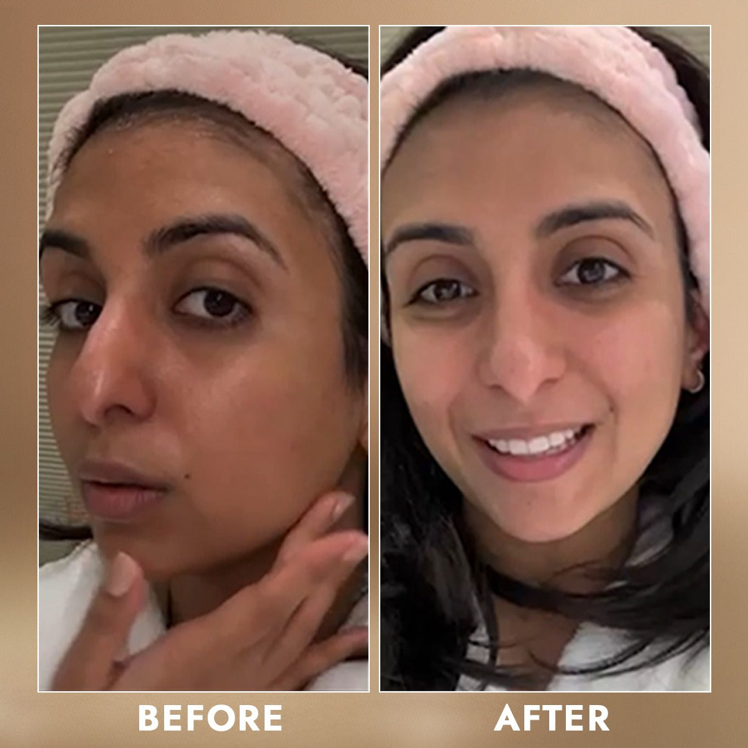 face mask for pigmentation