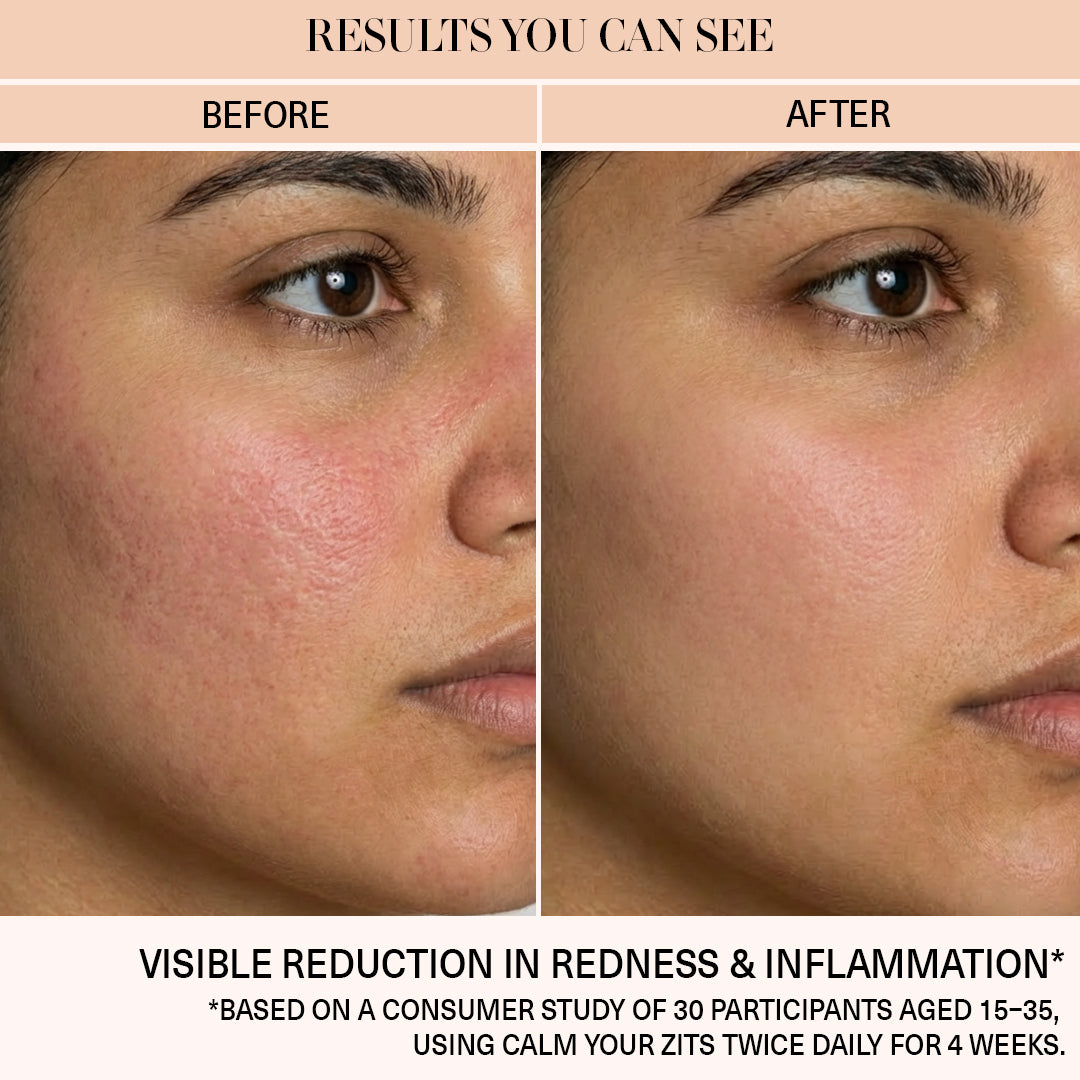 Calm Your Zits - Anti-Acne Gel