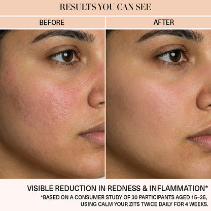 Calm Your Zits - Anti-Acne Gel