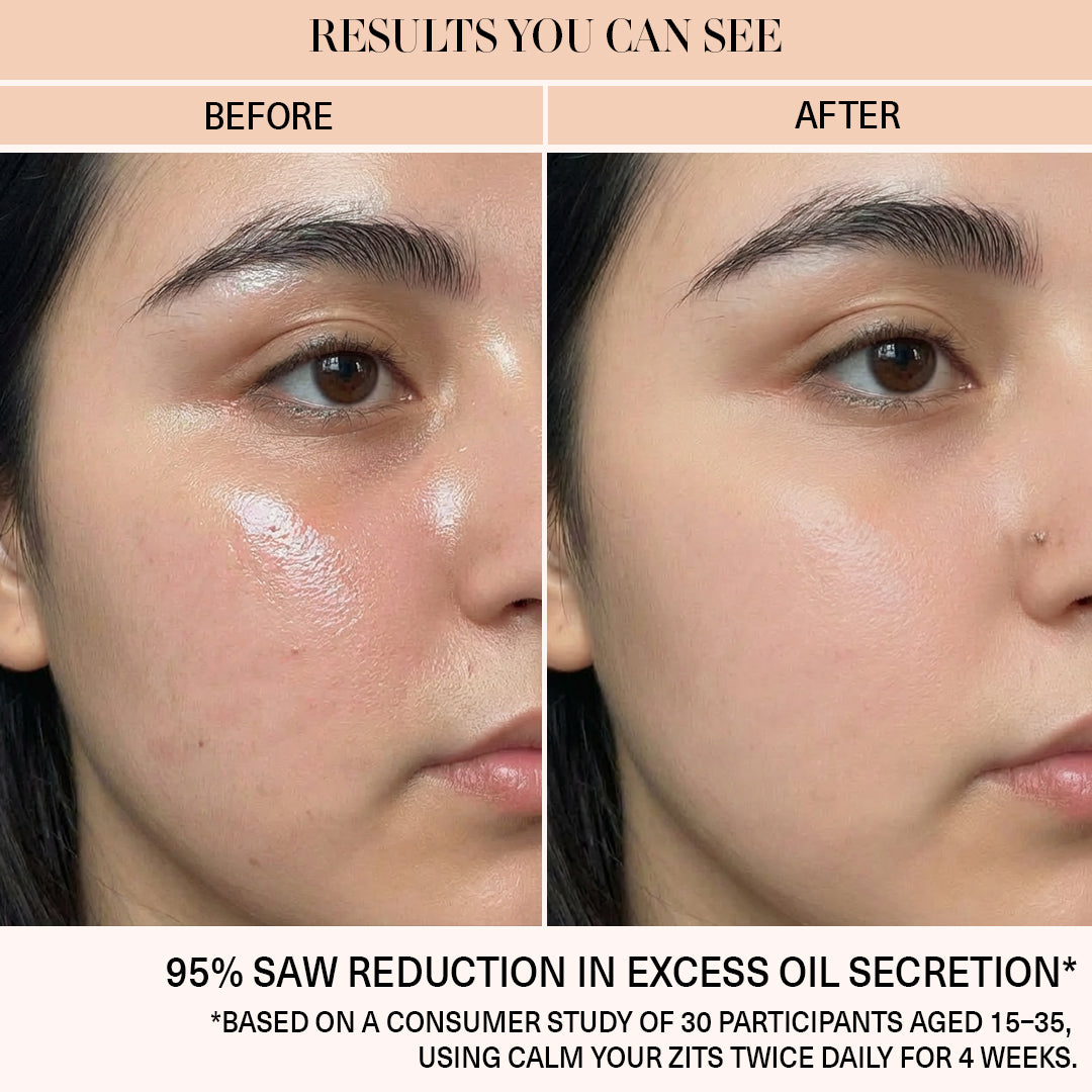 Calm Your Zits - Anti-Acne Gel