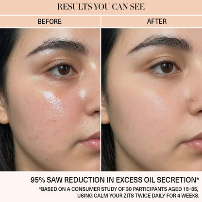 Calm Your Zits - Anti-Acne Gel