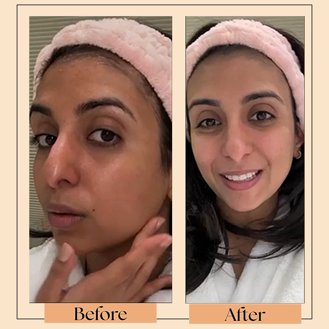 skin brightening treatment