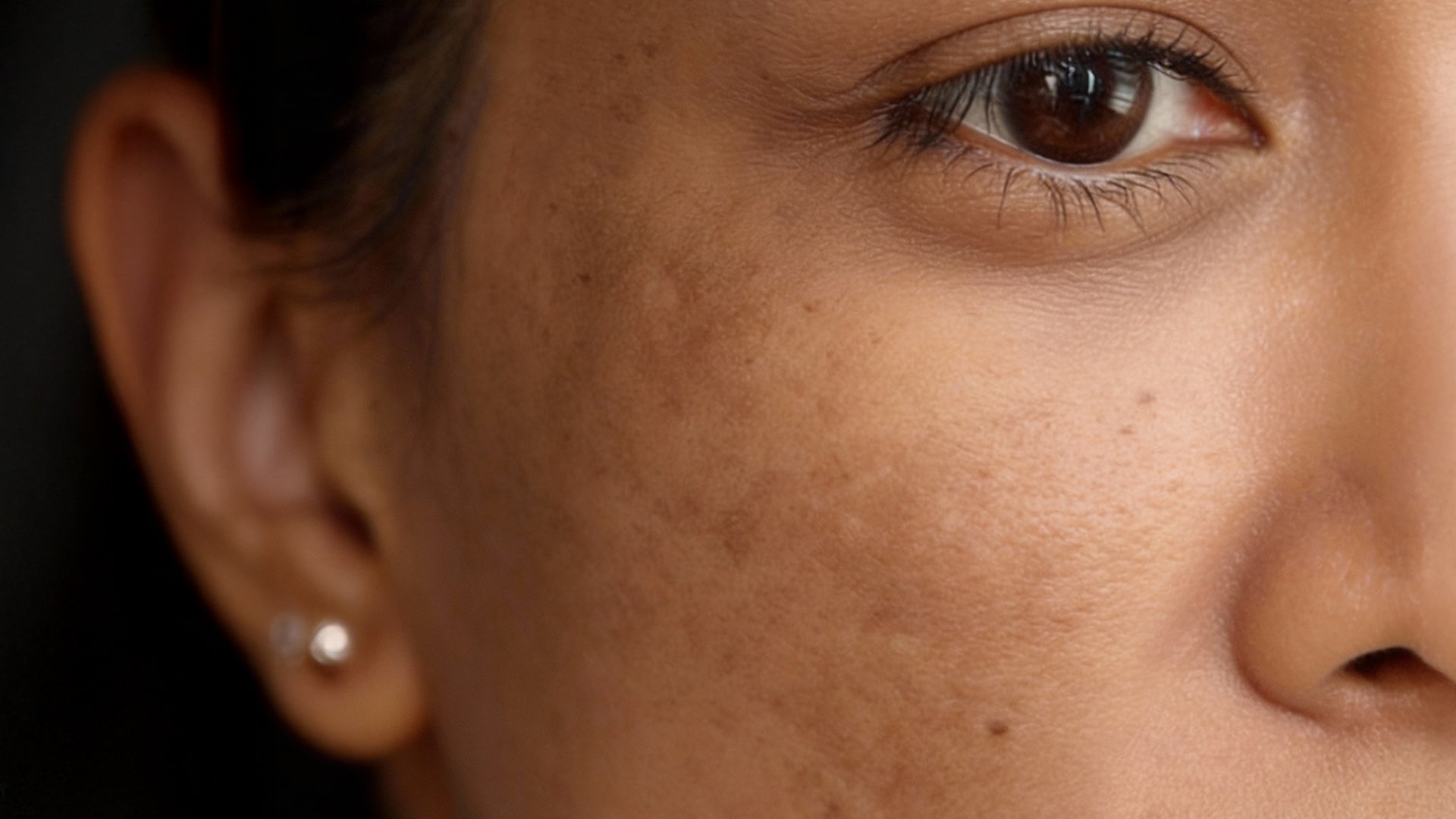 how to reduce hyperpigmentation